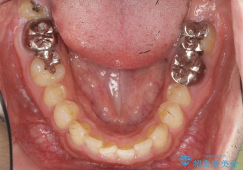 ディープバイトのマウスピース矯正の治療前