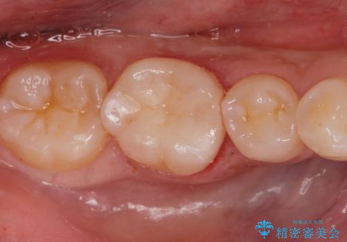 e-maxインレー治療。の治療後