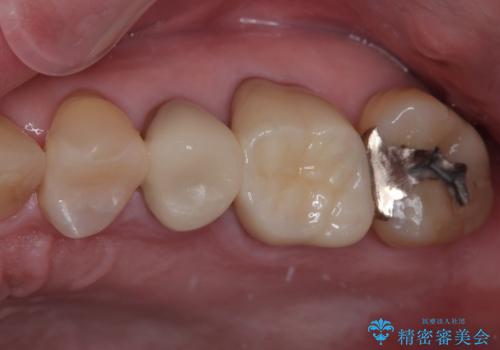 銀歯が取れたのでやり替えたい　セラミックインレー修復の治療後