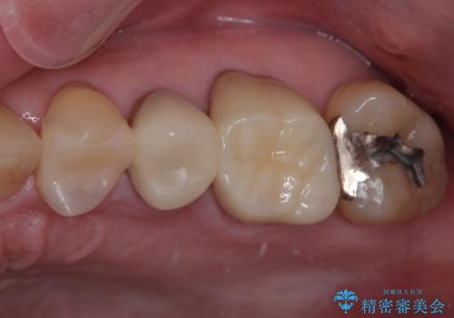 銀歯が取れたのでやり替えたい セラミックインレー修復の治療後