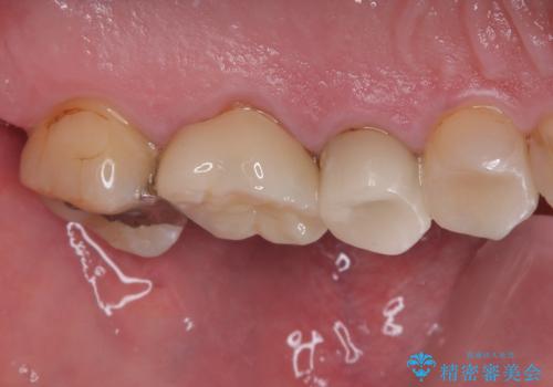 銀歯が取れたのでやり替えたい　セラミックインレー修復の治療後