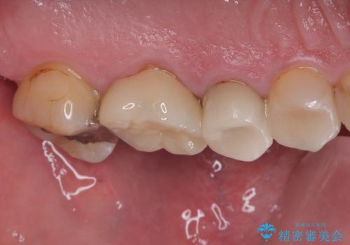 銀歯が取れたのでやり替えたい セラミックインレー修復の治療後