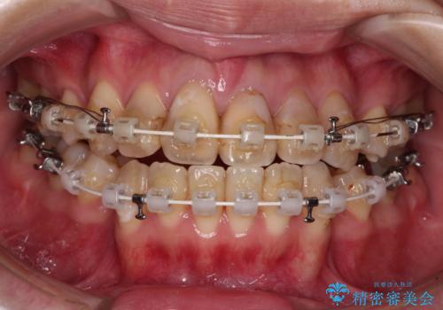 気になる八重歯と変色した前歯 抜歯矯正とセラミッククラウン治療の治療中