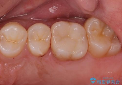 銀歯を無くしたい。の治療後