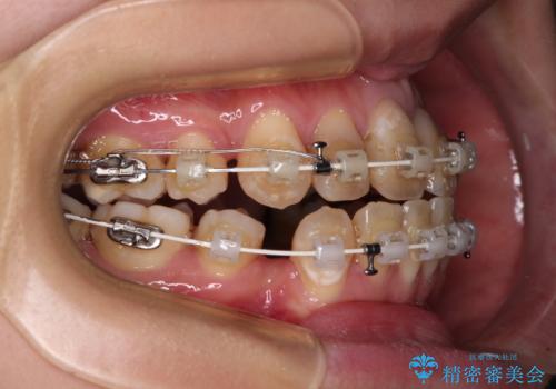 気になる八重歯と変色した前歯 抜歯矯正とセラミッククラウン治療の治療中