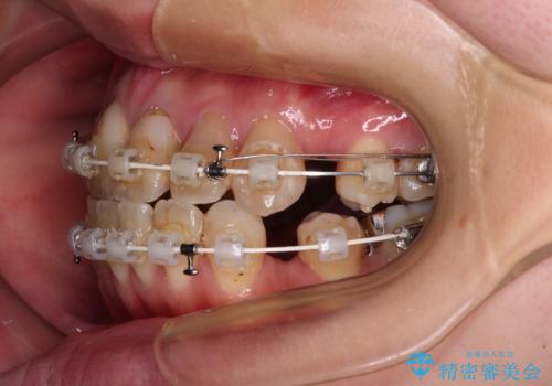 気になる八重歯と変色した前歯　抜歯矯正とセラミッククラウン治療の治療中