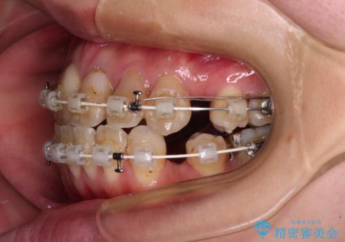 気になる八重歯と変色した前歯 抜歯矯正とセラミッククラウン治療の治療中