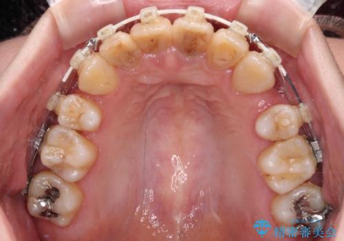 気になる八重歯と変色した前歯　抜歯矯正とセラミッククラウン治療の治療中