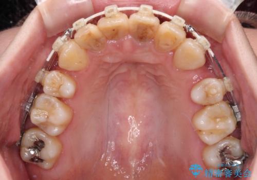 気になる八重歯と変色した前歯 抜歯矯正とセラミッククラウン治療の治療中