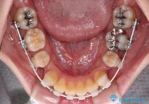 気になる八重歯と変色した前歯 抜歯矯正とセラミッククラウン治療の治療中