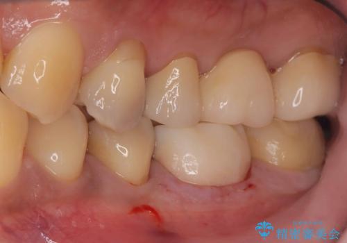 【セラミックインレー・フルジルコニアクラウン】2本の銀歯の下が虫歯にの治療中