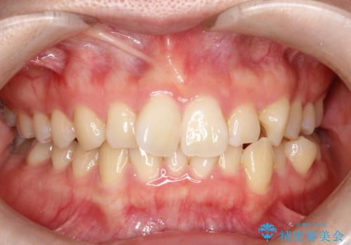 インビザラインで上下の叢生を改善の治療前