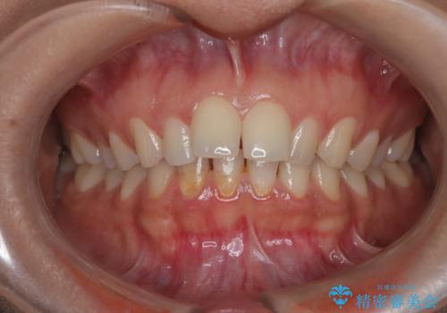 上顎前突を非抜歯で改善