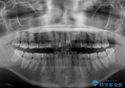 前に飛び出して目立っている前歯を整える　インビザライン矯正治療の治療前