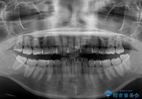 前に飛び出して目立っている前歯を整える インビザライン矯正治療の治療前