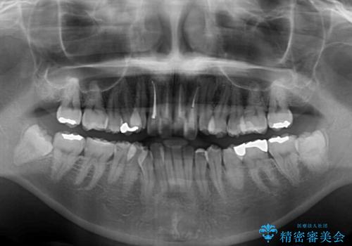 気になる八重歯と変色した前歯　抜歯矯正とセラミッククラウン治療の治療前