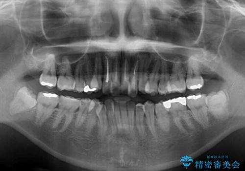 気になる八重歯と変色した前歯 抜歯矯正とセラミッククラウン治療の治療前