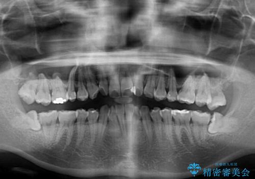 全く目立たないワイヤー矯正 上下裏側矯正の治療前