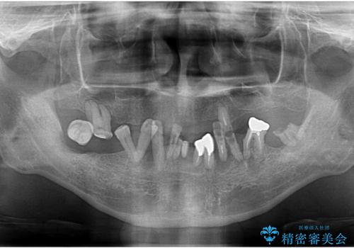 全体的に治したい。インプラントオーバーデンチャーによる治療。の治療前