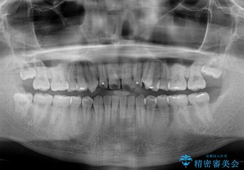 目立つ八重歯を非抜歯矯正で整える 目立たないワイヤー矯正の治療前