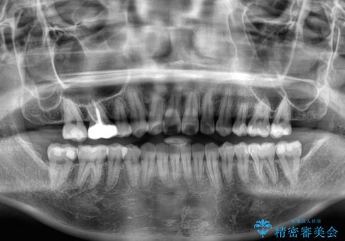 再矯正　開咬に後戻りした歯列をインビザラインで改善の治療後