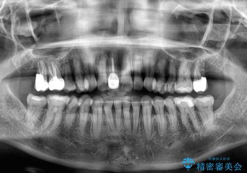 デコボコと銀歯 矯正治療とセラミック治療で綺麗な口元にの治療後