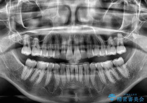 前に飛び出して目立っている前歯を整える　インビザライン矯正治療の治療後
