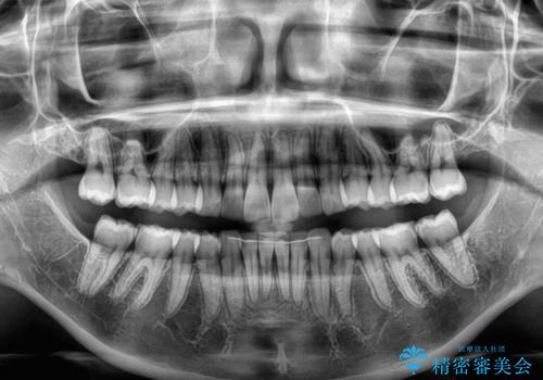 前に飛び出して目立っている前歯を整える インビザライン矯正治療の治療後