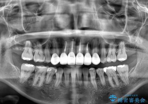気になる八重歯と変色した前歯　抜歯矯正とセラミッククラウン治療の治療後