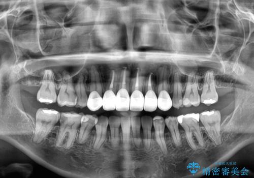 気になる八重歯と変色した前歯 抜歯矯正とセラミッククラウン治療の治療後