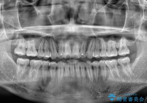 目立つ八重歯を非抜歯矯正で整える 目立たないワイヤー矯正の治療後