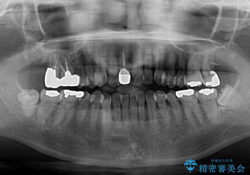デコボコと銀歯 矯正治療とセラミック治療で綺麗な口元にの治療前