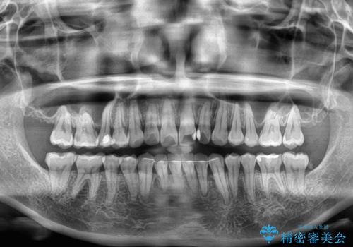 全く目立たないワイヤー矯正 上下裏側矯正の治療後