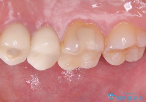 【セラミッククラウン】銀の詰め物していた歯が割れたの治療後