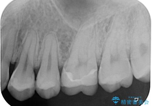 神経を守る治療　即日セラミック修復の治療後