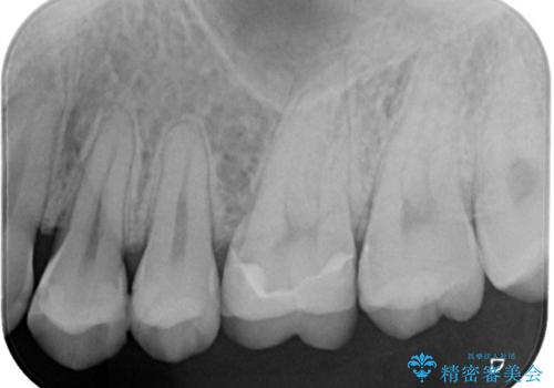神経を守る治療 即日セラミック修復の治療後