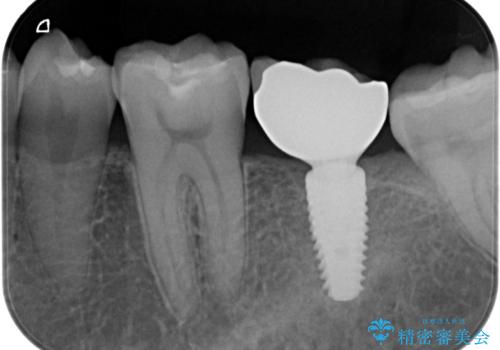 奥歯のインプラントの治療後