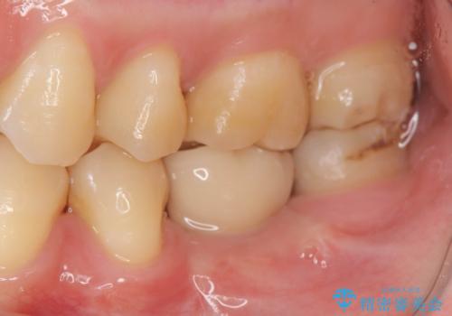 大臼歯の欠損 インプラント治療の治療後