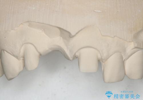 前歯ブリッジのやり変え希望 オールセラミッククラウンの治療中