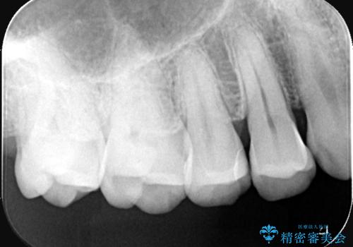 【セラミックインレー】海外に行く前に虫歯治療してほしいの治療後