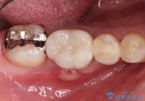 歯茎が腫れた。ジルコニアクラウンやりかえ。の症例 治療前