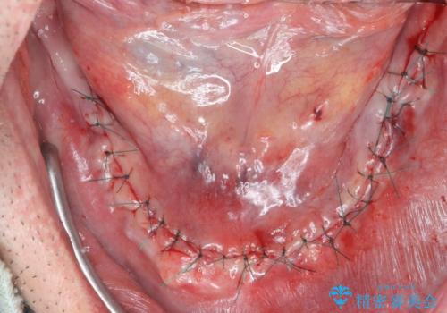 全体的に治したい。インプラントオーバーデンチャーによる治療。の治療後