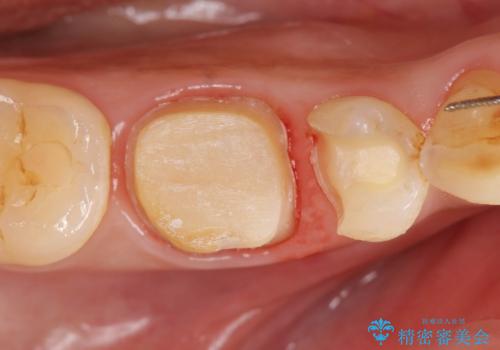 治療途中の歯　セラミック治療を希望され来院の治療中