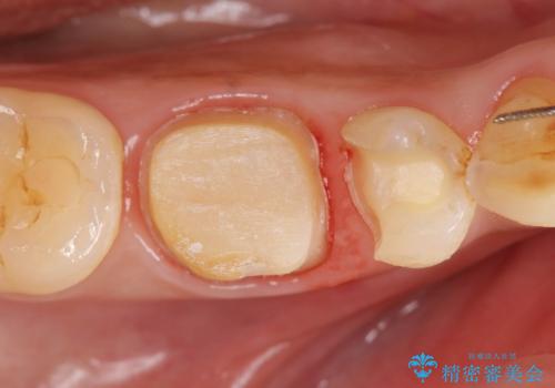 治療途中の歯 セラミック治療を希望され来院の治療中