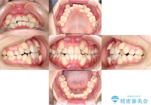 【ワイヤー矯正】八重歯　歯のでこぼこを治したい!の治療前