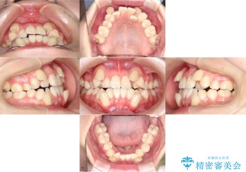 【ワイヤー矯正】八重歯 歯のでこぼこを治したい!の治療前