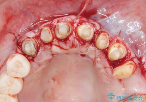 [ 歯ぐきから出血をする ]　歯周外科を伴うセラミックやりかえ治療の治療中