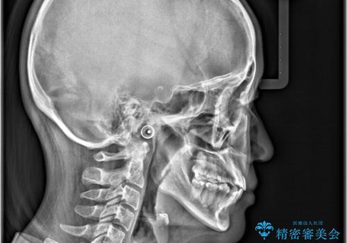 【ワイヤー矯正】八重歯 歯のでこぼこを治したい!の治療後