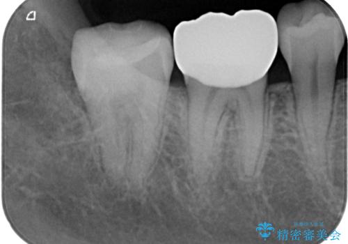 銀歯をやり替えたい フルジルコニアクラウン・セラミックインレー修復の治療後