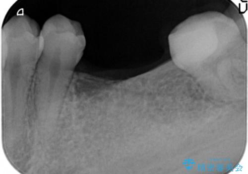 奥歯のインプラントの治療前